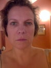 full face.  You can't really see lumps all the time, just in certain light, or when they get inflamed.  I have two visible white lumps on either side of my chin, just below the corners of my lips. They seem to swell, and at times retain water.. I have had several juvederm injections, under my eyes last sumer, and Nasolabial folds, lipline and around mouth a couple years ago