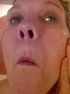 You can kind of see lumps under mouth, they don't look that bad, but they are actually white and about 10mm x 13mm with a dent in them, after being injected with saline...
