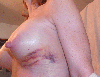Bra bruising on left breast