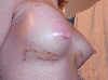 Bra bruising on right breast