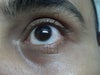 Lesions
