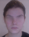 I had a jaw surgery but this did not help the surgeon also sayed about 1 year after nothing had changed so I still had an underbite.