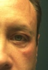 After 2nd surgery (taken today 8/13)
