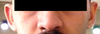 Front view, before Otoplasty: note that my ears are naturally uneven, with the left ear having a sharp antihelical fold.