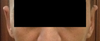 Front view, after Otoplasty: the sharp antihelical fold in my LEFT ear makes hard to see the outer helix from the front.