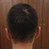 Back view, after Otoplasty.