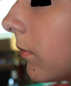 21 y/o female (Lower Face Side Profile)