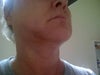 Indention and puffiness under and along jawline