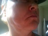 Indention and puffiness under and along jawline