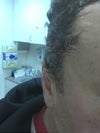 see the extra long incision and staples
