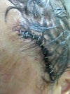 see the extra long incision and staples the other side