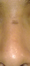 Straight shot of scar on nose.