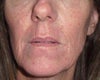 2 weeks after fractural laser for smile lines