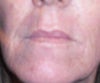 2 weeks after fractural laser for smile lines