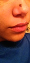 My mole is a dark brown color, raised, and on my nose. Also, it hasn't grown any over the years.