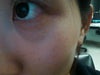 This picture is after 4days of treatment