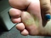 Taken today after last Pulse Dye Laser treatment back in May (Haven't been back since)