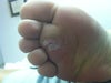 after shaved down to see all the warts before Pulse Dye surgery in May