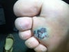 After Pulse Dye Laser surgery in May