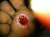 after 1st CO2 Laser; healing process