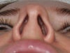 pre-op