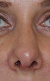 post-op 25 d