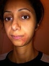 This is the day after laser, I've used the medications I mentioned in the above articles.