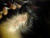 Left top hair loss taken on 8/16/12