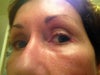 Red bump on corner of eye.  First red bump over other eyebrow.