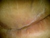 greenish scab on LEFT side where the swelling has created almost like a hard "shelf/ledge" above the incision - I'm on Bactrim for 5 days now, 5 more to go. Putting Polysporin on the entire incision.