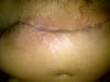stretch marks MIDDLE/FRONT and spreading down to labia - will this go away eventually?