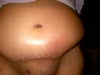 this photo was taken in a MIRROR so look at the RIGHT side of my body (actually it's my left side) - swelling is like a shelf/ledge above my incision - normal?