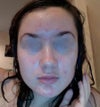 This is disgusting me, 8 days after starting Retin-A.