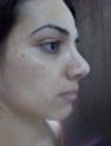rhinoplasty after two months