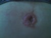 this is my bellybutton keloiding 8 months after a tt