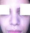 Lumps under my eyes visible. 28 days post-rhino