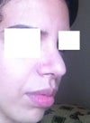 swollen tip or pollybeak? 28 post-rhino