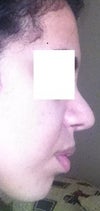 swollen tip or pollybeak? 28 post-rhino