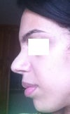 swollen tip or pollybeak? 28 post-rhino