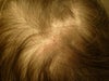 back crown