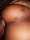 right breast