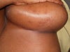 left breast-not as bad