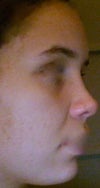 New Nose side view 4 months out. Short tip, flattened bridge.