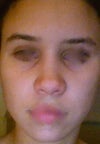 Shortened tip, flaring nostrils (piggy) & no refinement at all!!! Tip isnt dropping.