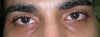 dark circles
