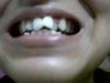 i have bad teeth structure :( i m scared if braces will work on me or worsen me!