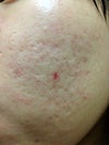 Current condition of acne scars on my face after a few treatments