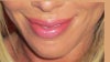 Smile lines, unhappy with lower face altogether