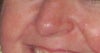 Red and bumpy area around nose and mouth