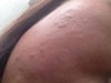 bumps on cheeks